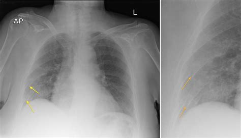 mri for broken ribs